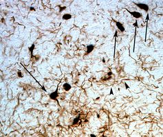 Neurofibrillary tangles